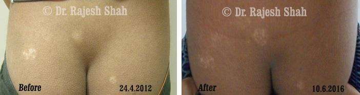 Vitiligo Before and After Case Photo
