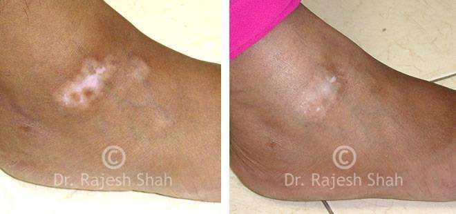 Vitiligo Before and After Case Photo