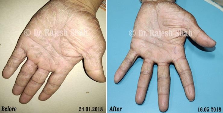 Atopic Dermatitis Before and After Case Photo