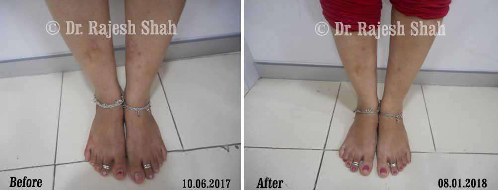 Psoriasis Before and After Case Photo