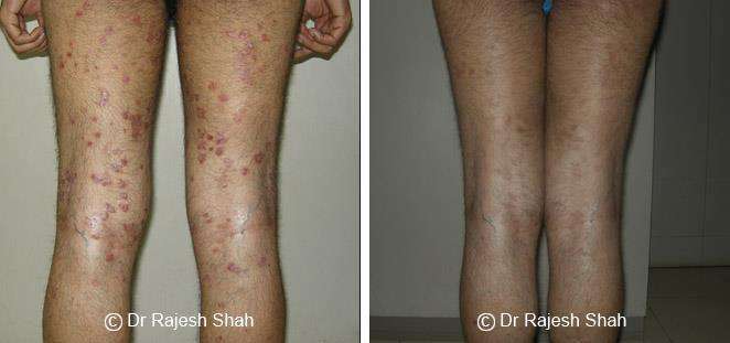 Psoriasis Before and After Case Photo