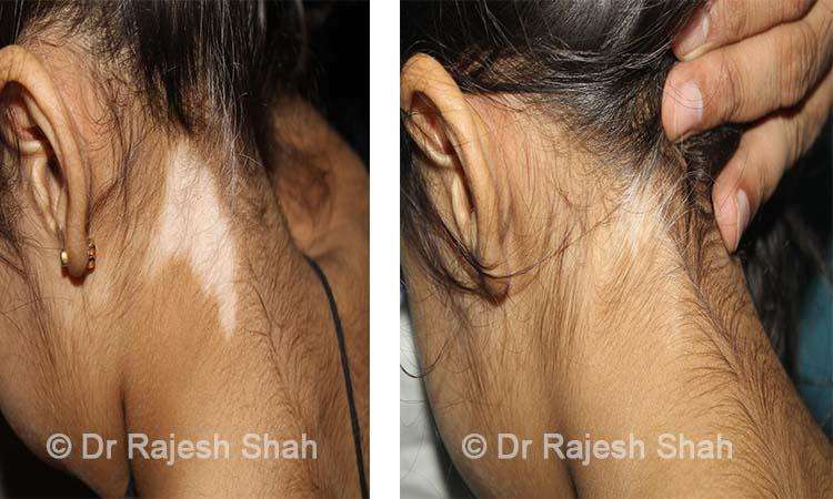 Vitiligo Before and After Case Photo