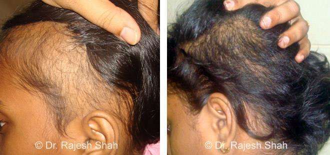 Alopecia Areata Before and After Case Photo