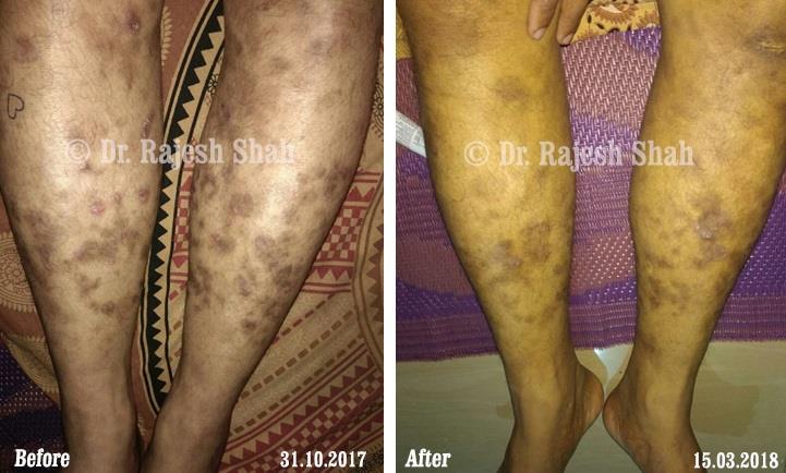 Psoriasis Before and After Case Photo