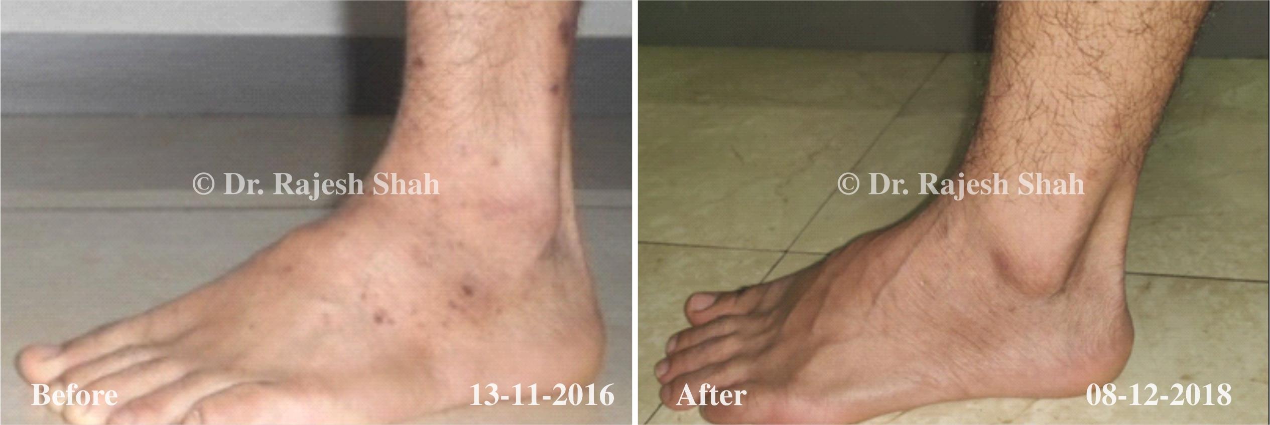 Lichen Planus Before and After Case Photo