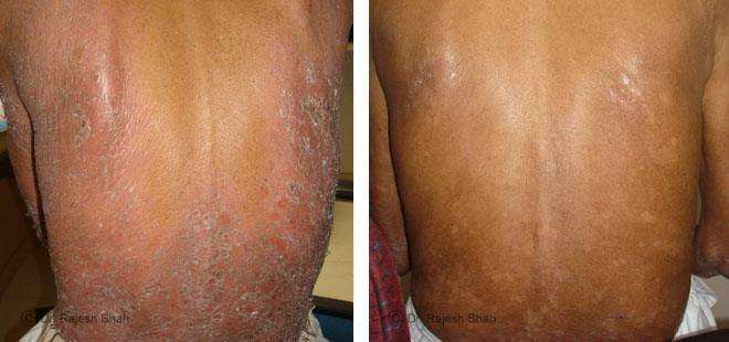 Psoriasis Before and After Case Photo