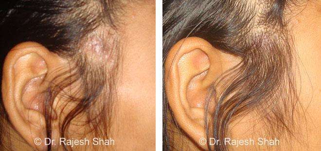 Hair loss Before and After Case Photo