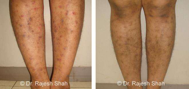 Lichen Planus Before and After Case Photo