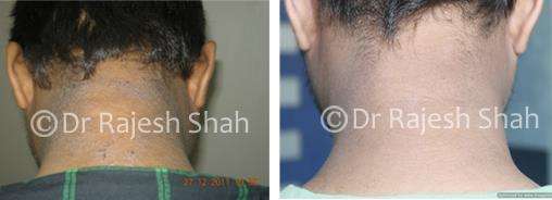 Eczema Before and After Case Photo