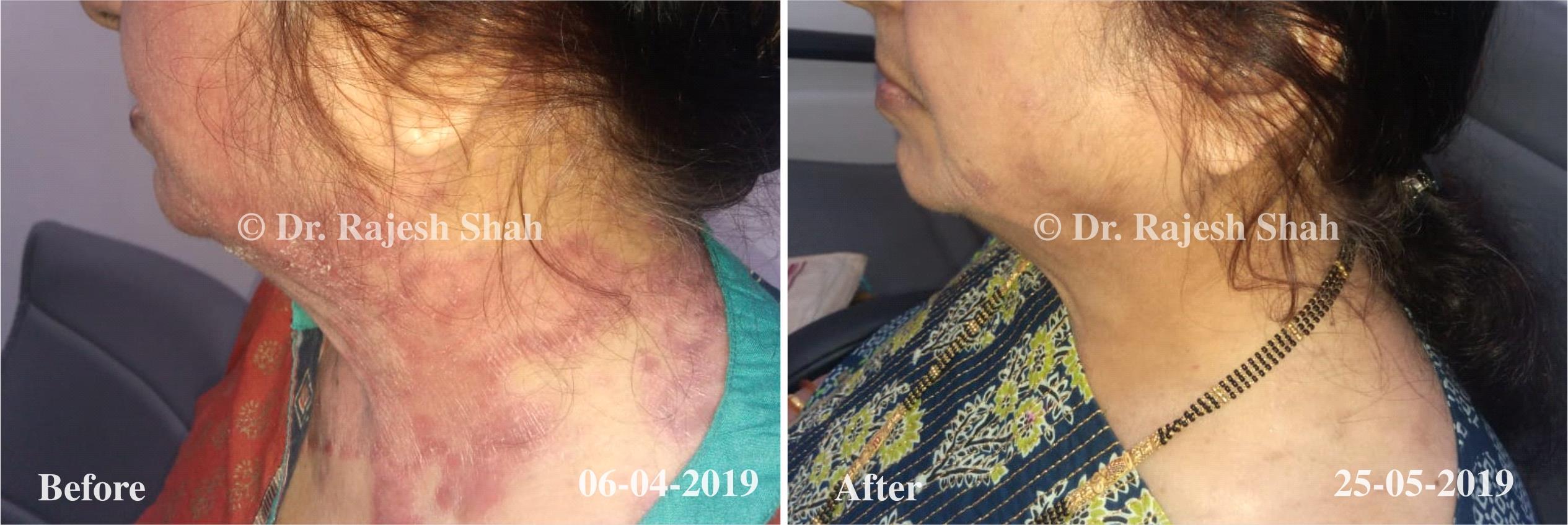 Psoriasis Before and After Case Photo