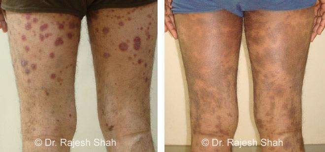 Psoriasis Before and After Case Photo