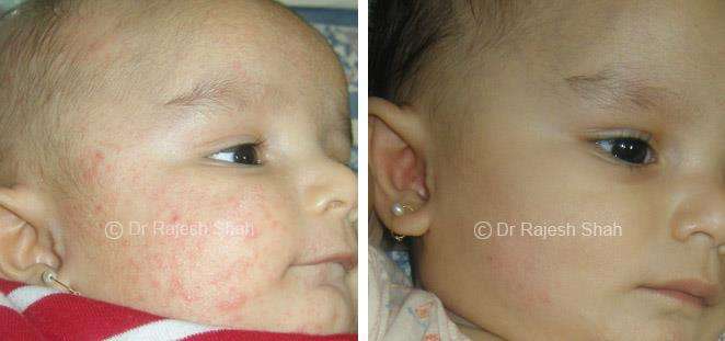 Atopic Dermatitis Before and After Case Photo