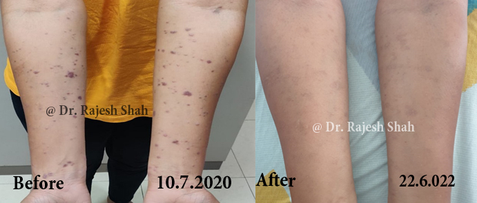 Lichen Planus Before and After Case Photo