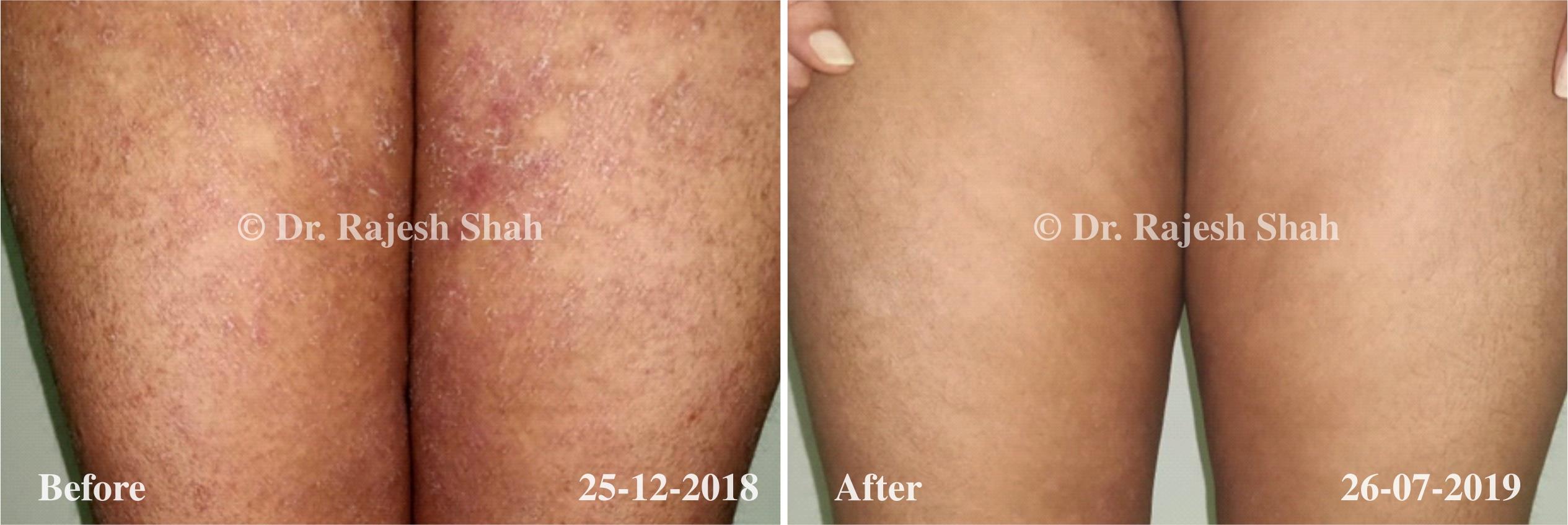 Psoriasis Before and After Case Photo