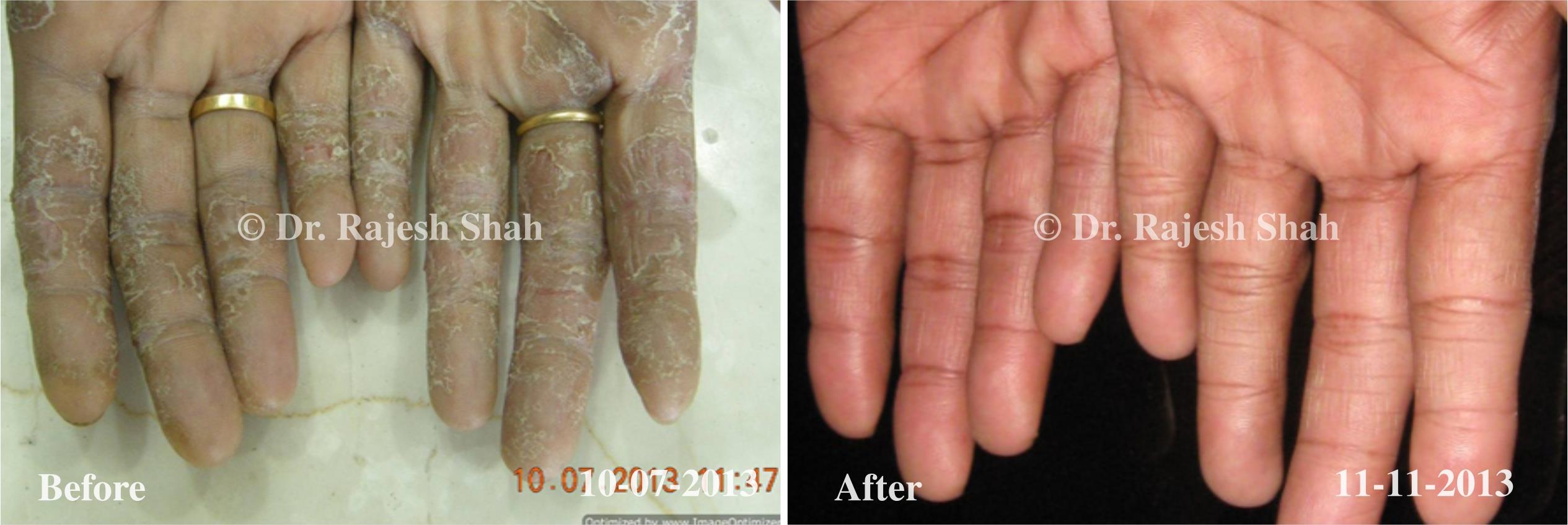 Psoriasis Before and After Case Photo