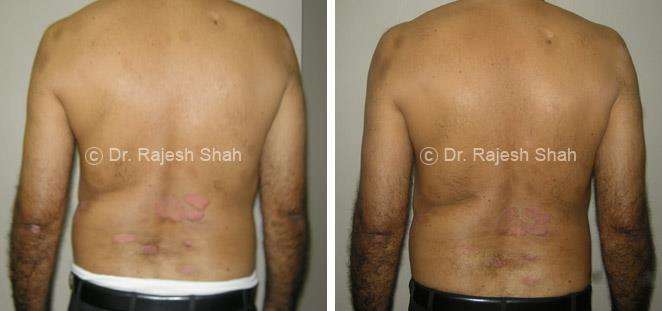 Psoriasis Before and After Case Photo