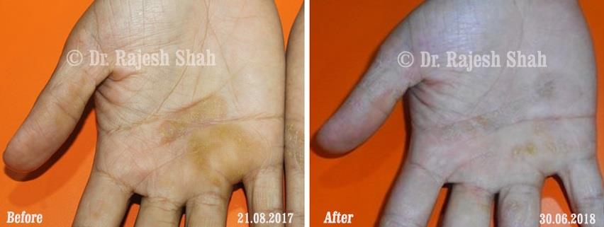 Psoriasis Before and After Case Photo