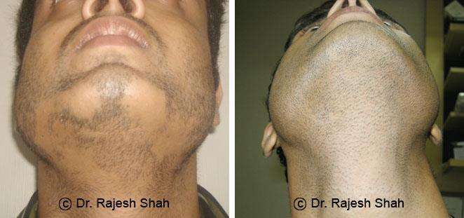 Alopecia Areata Before and After Case Photo