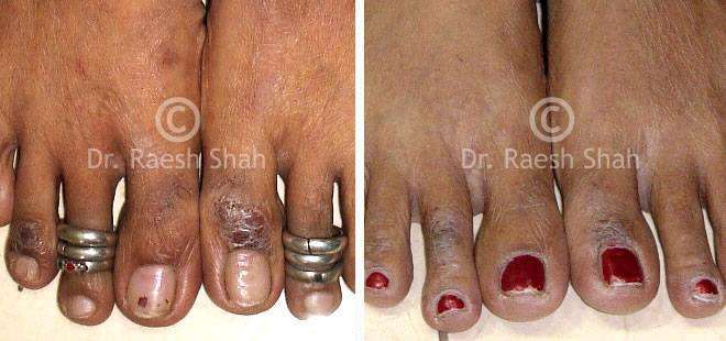 Eczema Before and After Case Photo