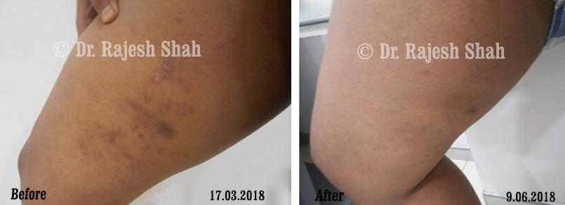 Alopecia Areata Before and After Case Photo