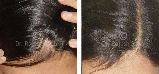 Alopecia Areata Before and After Case Photo