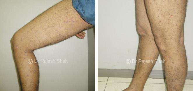 Lichen Planus Before and After Case Photo