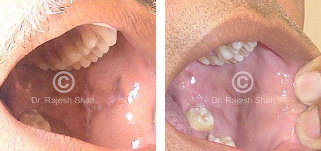 Lichen Planus Before and After Case Photo