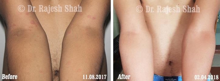 Lichen Planus Before and After Case Photo