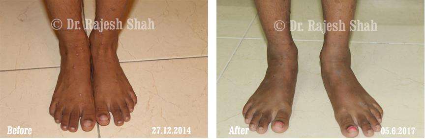Lichen Planus Before and After Case Photo