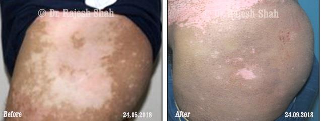 Vitiligo Before and After Case Photo