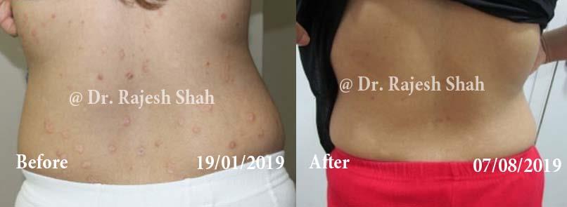 Psoriasis Before and After Case Photo