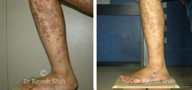 Lichen Planus Before and After Case Photo