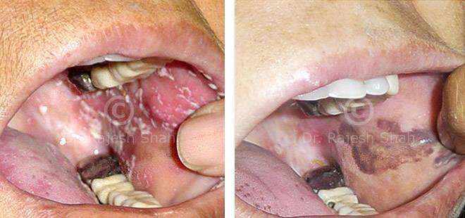 Lichen Planus Before and After Case Photo