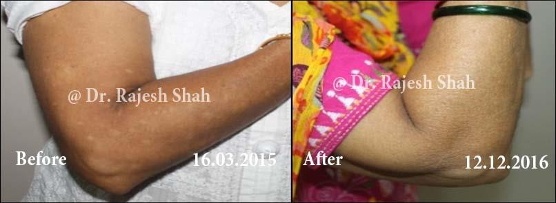 Vitiligo Before and After Case Photo