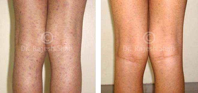 Lichen Planus Before and After Case Photo