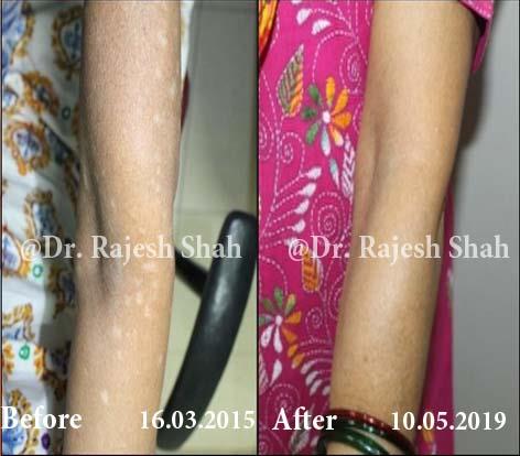 Vitiligo Before and After Case Photo