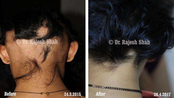 Alopecia Areata Before and After Case Photo