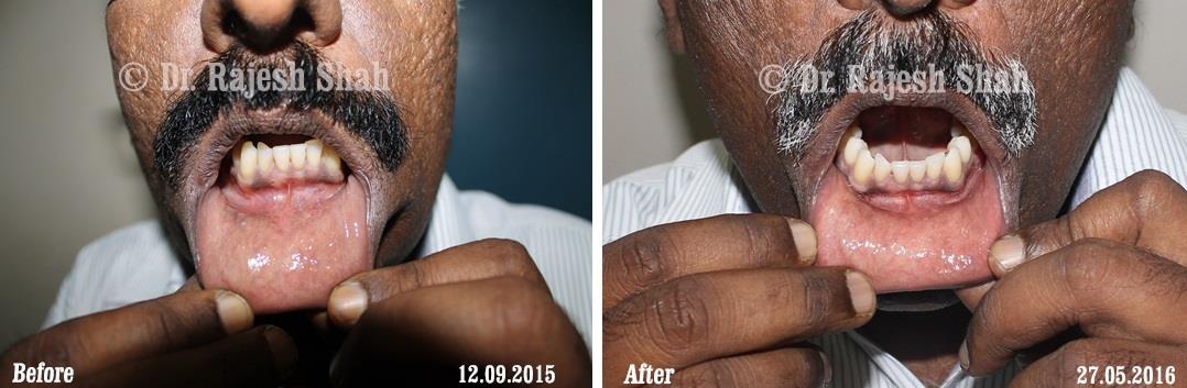 Lichen Planus Before and After Case Photo