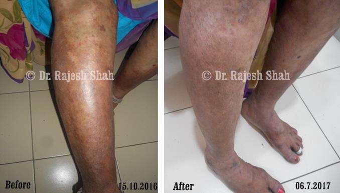 Psoriasis Before and After Case Photo