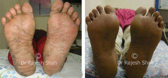 Psoriasis Before and After Case Photo