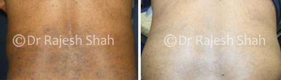 Lichen Planus Before and After Case Photo