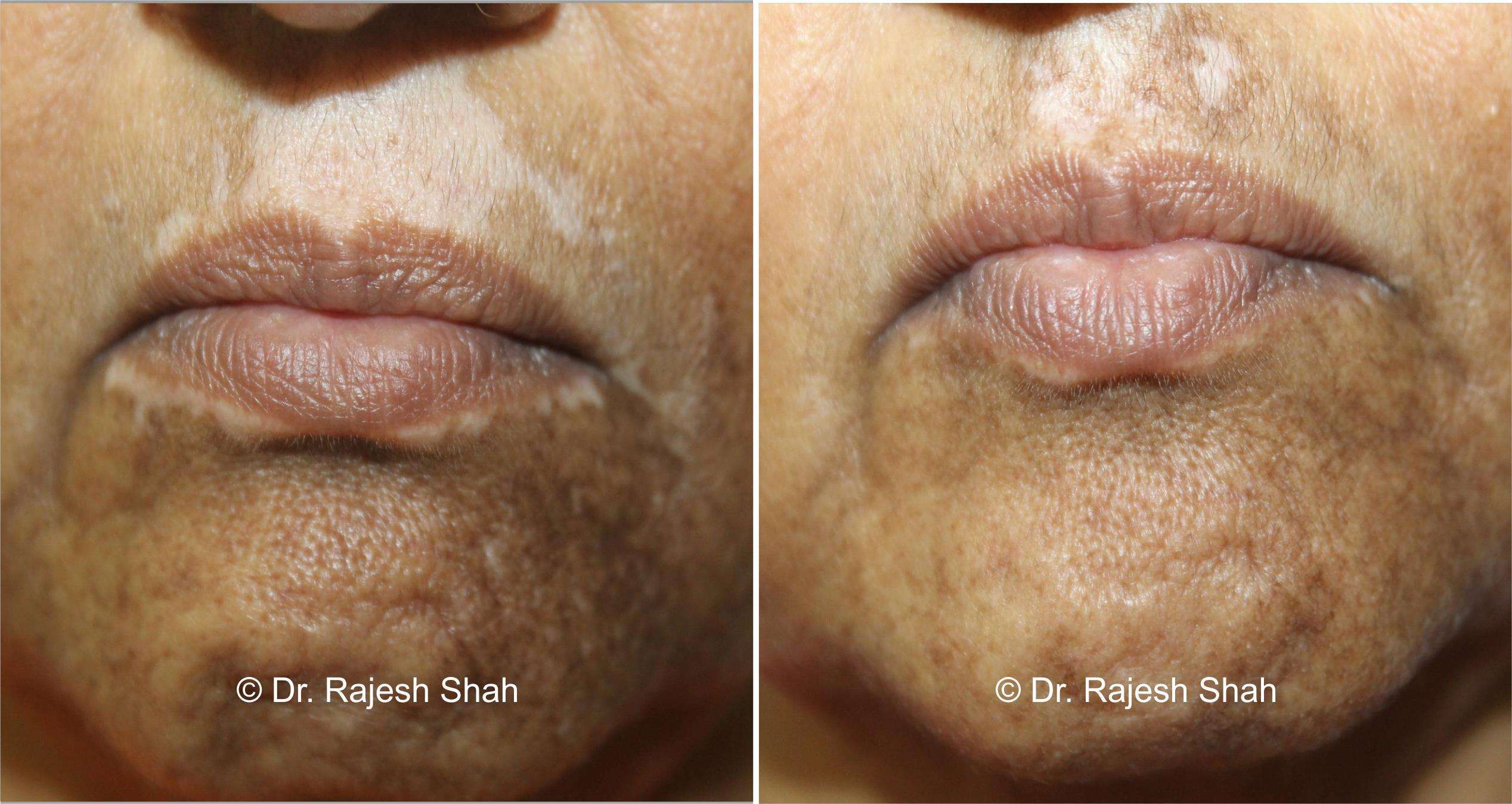 Vitiligo Before and After Case Photo