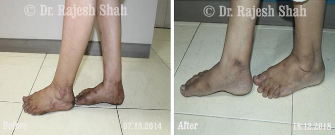 Psoriasis Before and After Case Photo