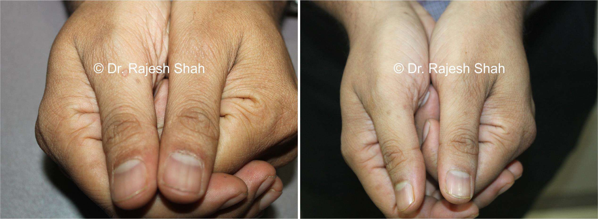 Lichen Planus Before and After Case Photo