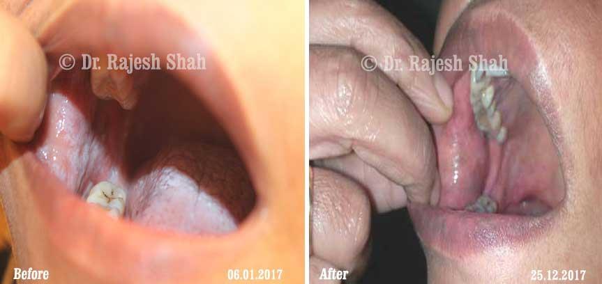 Lichen Planus Before and After Case Photo