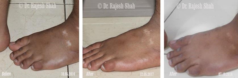 Vitiligo Before and After Case Photo