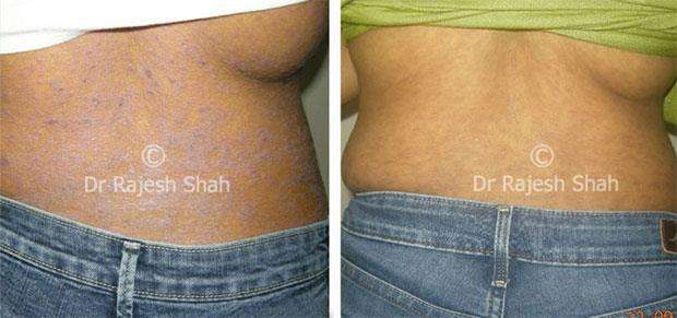 Lichen Planus Before and After Case Photo