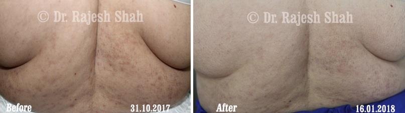 Lichen Planus Before and After Case Photo