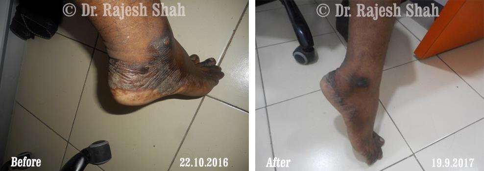 Psoriasis Before and After Case Photo