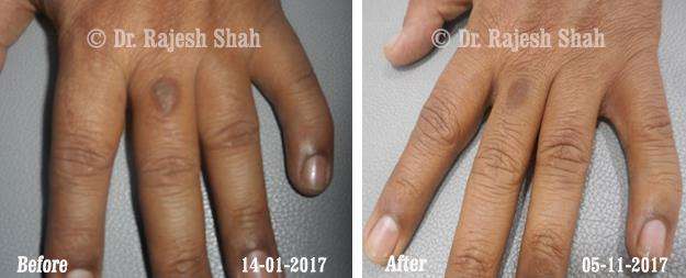 Atopic Dermatitis Before and After Case Photo